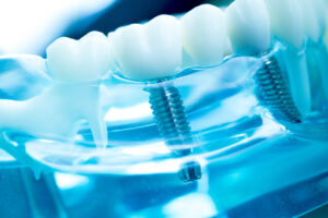 shrewsbury dental implants