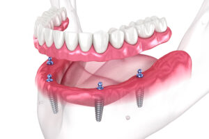 shrewsbury implant dentures