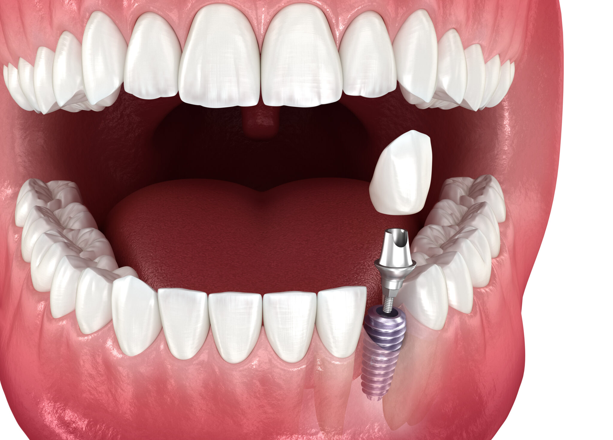 How We Ensure Implants Look Natural - Shrewsbury Implant