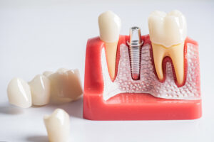 shrewsbury dental implants