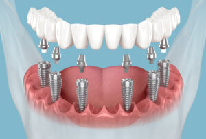 shrewsbury hybrid dentures