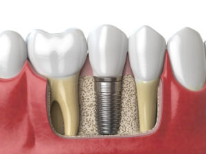 shrewsbury dental implant placement