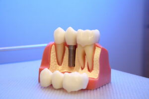 shrewsbury dental implants