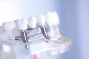 shrewsbury dental implants