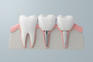 shrewsbury dental implant technology