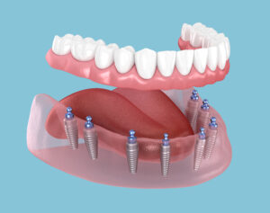 shrewsbury dental implants