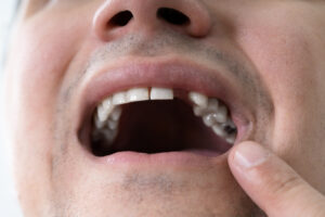 shrewsbury missing teeth